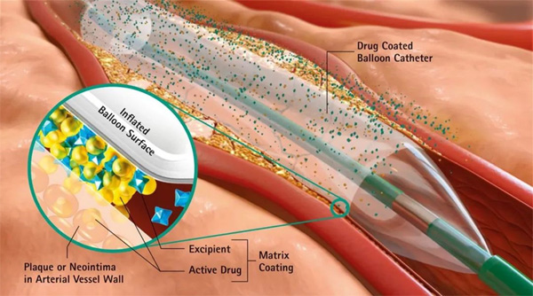 Drug-coated balloon