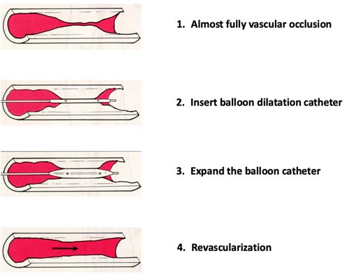 balloon catheter