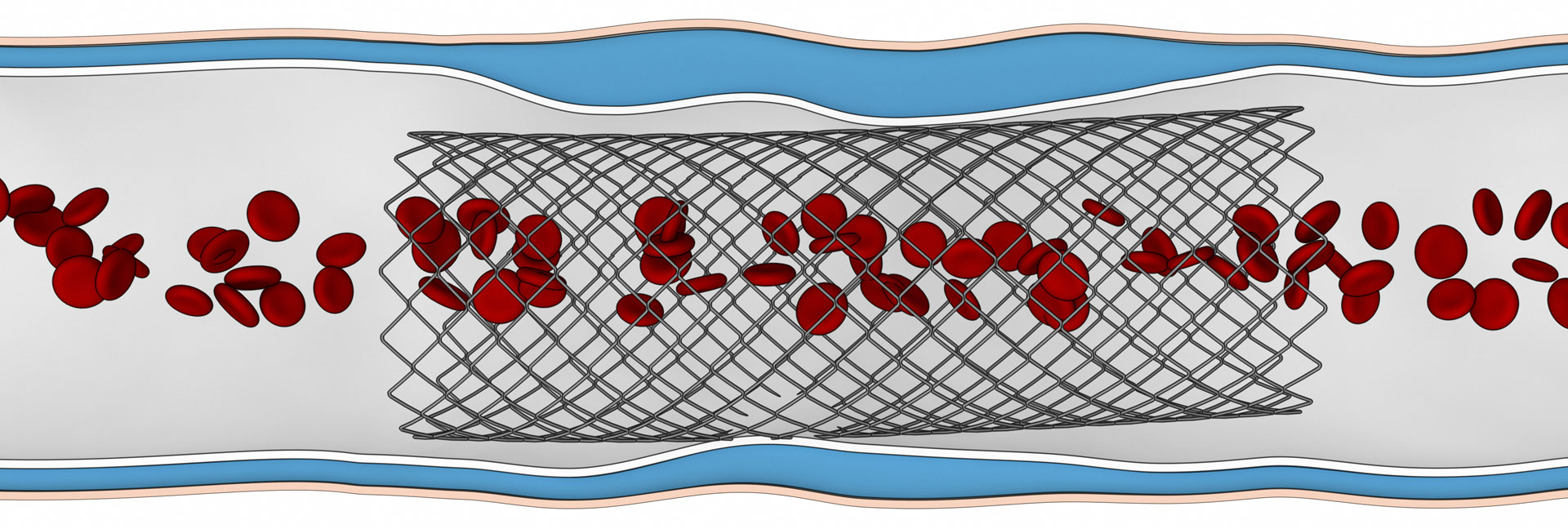 Coronary Stent System