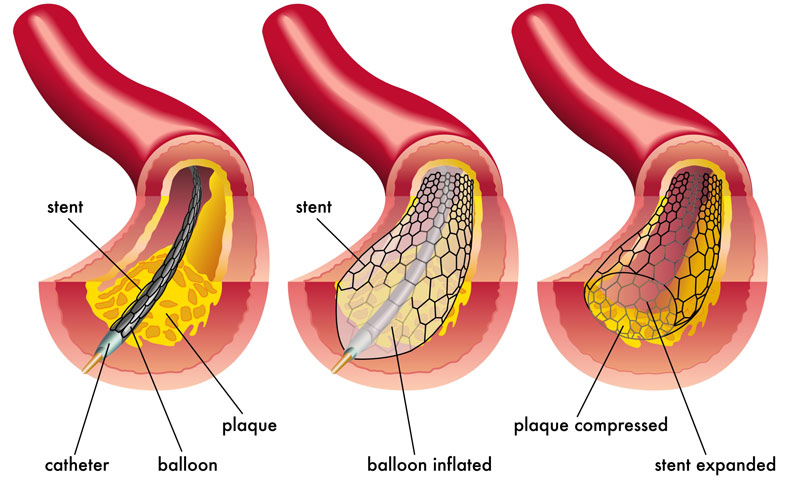 Coronary Stent System