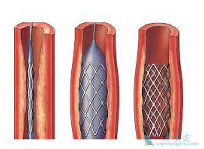 PTCA BALLOON DILATATION CATHETER